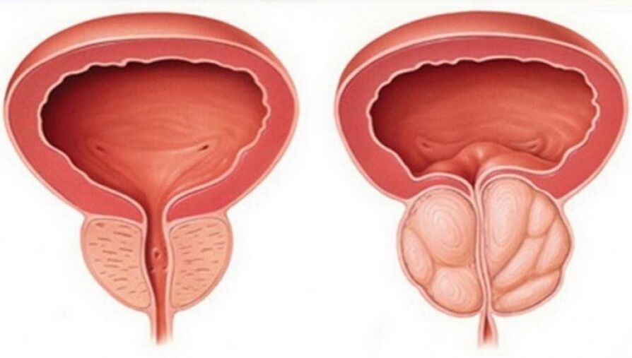 prostatit ile sağlıklı ve iltihaplı prostat