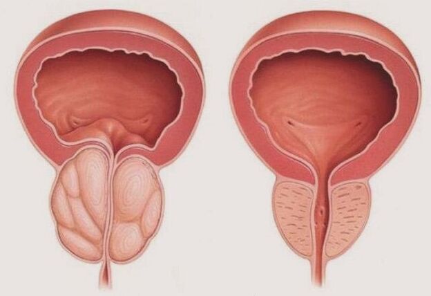 prostatit ile sağlıklı ve iltihaplı prostat