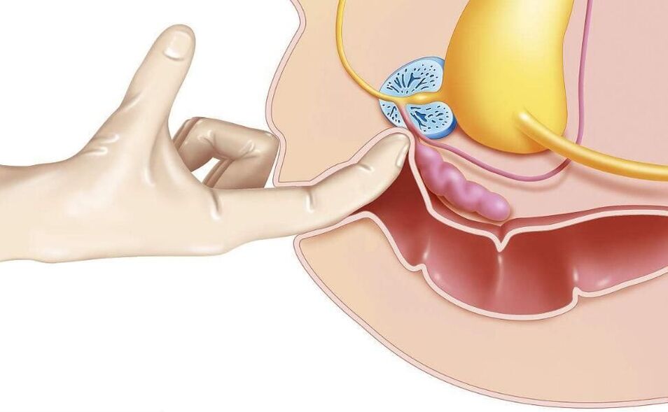 prostatit tedavisi için prostat masajı